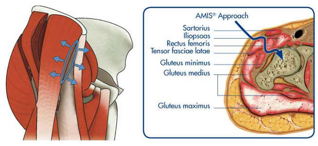 Anterior Hip Surgery