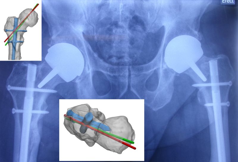 Complex Hip Resurfacing Arthroplasty